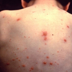 Eczema Red Spots