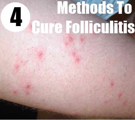 Folliculitis Treatment, Causes, and Home Remedies