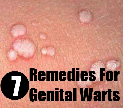 Genital warts Treatment - Mayo Clinic