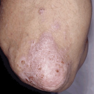 Vinegar For Treating Skin Problems