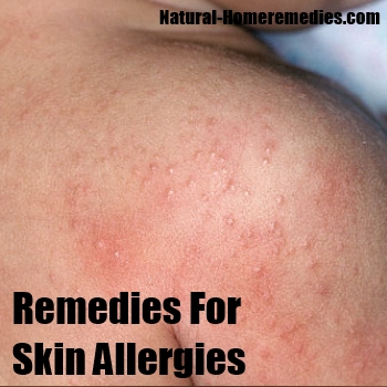 Home Remedies for Skin allergies  Treatment amp; Cure  Natural Remedy 