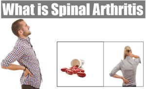 Natural Cures For Spinal Arthritis Natural Cures For Spinal Arthritis