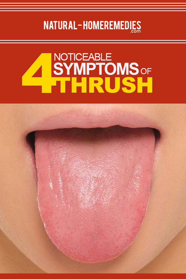 Various Noticeable Symptoms Of Thrush - Tips To Identify ...