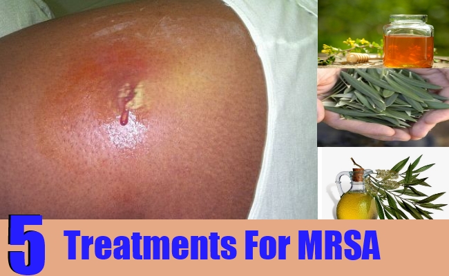 can bactrim cure staph infection
