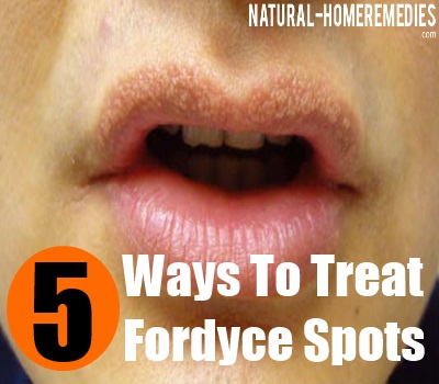 Can You Pop Fordyce Spots On Shaft How Do You Get Rid Of Pimples On Your Face Overnight Pregnancy Week By Week Symptoms And Pictures Fordyce Spots Treatment Natural How To Get Rid Of Marks In One Day