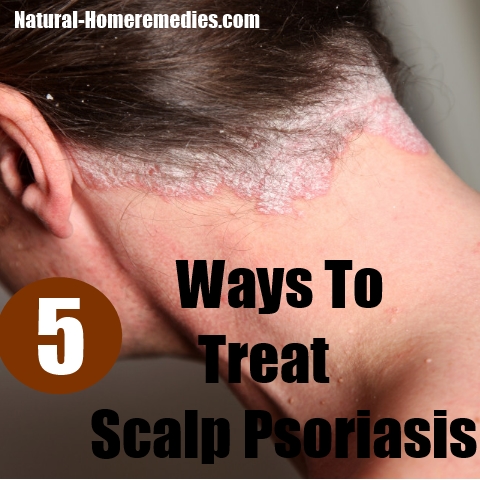 scalp psoriasis treatments