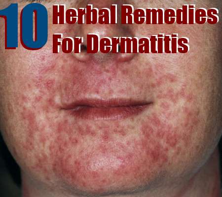 To Treat Dermatitis With Herbs Natural Home Remedies amp; Supplements To Treat Dermatitis With Herbs Natural Home Remedies amp; Supplements