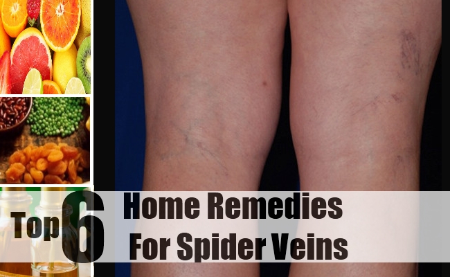 how to treat spider veins at home