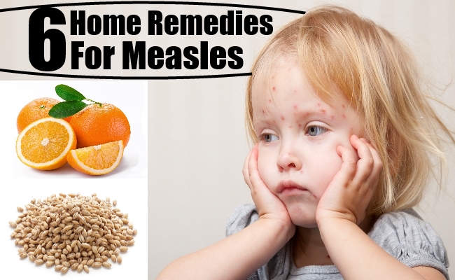 Measles Treatment Natural Remedies Measles Treatment Natural Remedies