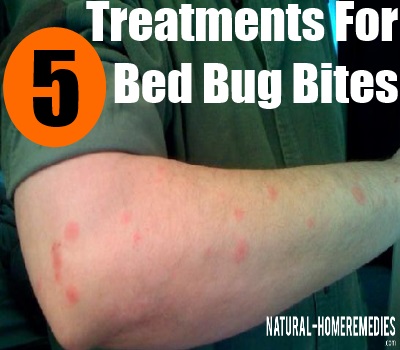 Effective Treatments For Bed Bug Bites - How To Treat Bed Bug Bites ...