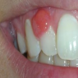 Home Remedies For Infected Gums And Teeth Home Remedies For Infected Gums And Teeth