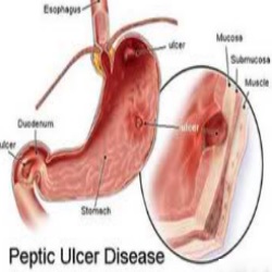 How To Cure Bleeding Ulcer Naturally How To Cure Bleeding Ulcer Naturally