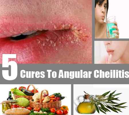 angular cheilitis cures #10