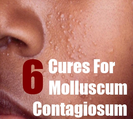 Molluscum+Contagiosum+Home+Remedy  Molluscum Contagiosum Naturally 