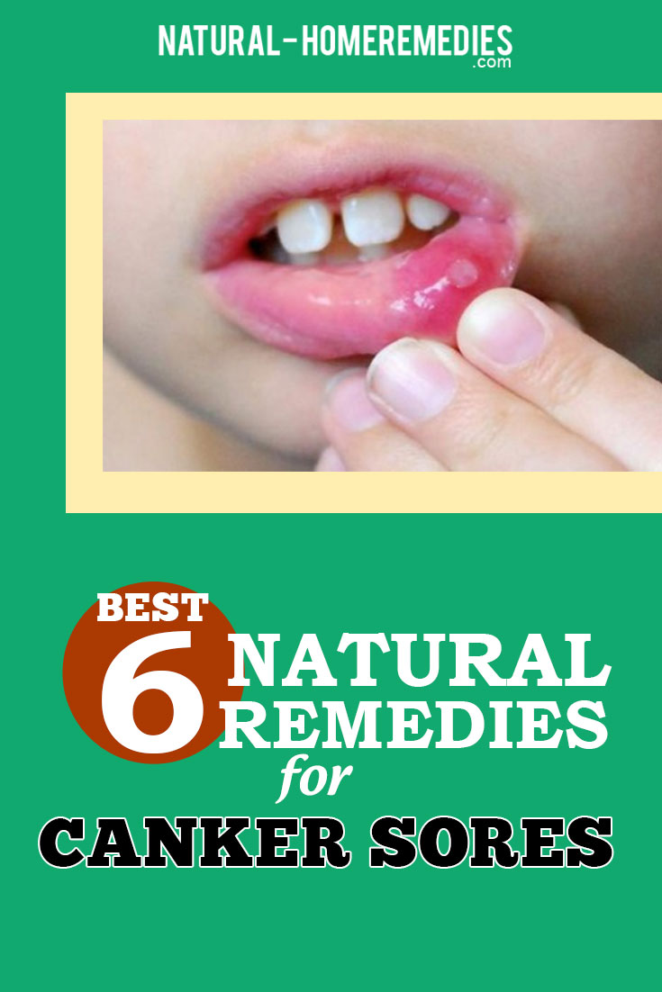 Canker Sores Natural Treatments And Cures | Natural Home ...