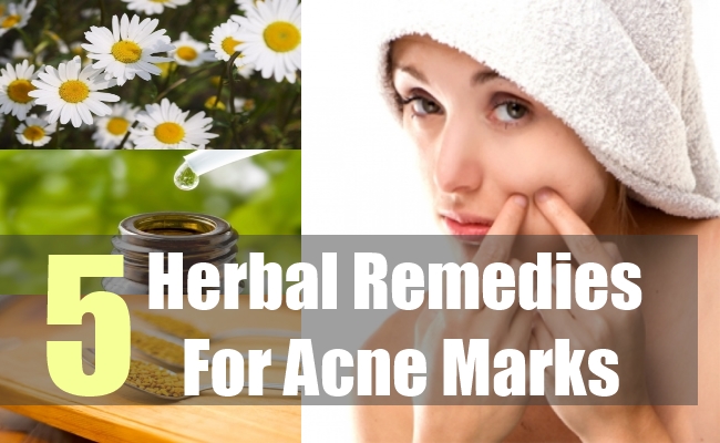 5 Excellent Herbal Remedies For Acne Marks - Natural Home ...