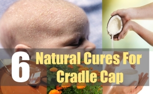 Natural Cures For Cradle Cap In Infants Natural Cures For Cradle Cap In Infants