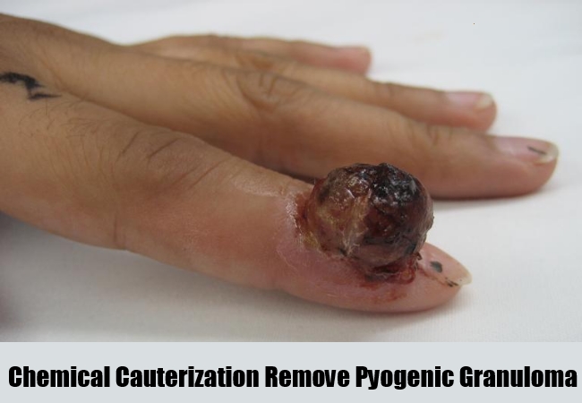 Natural Remedies For Pyogenic Granuloma Natural Remedies For Pyogenic Granuloma