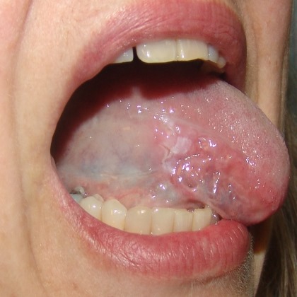 Oral Thrush: Causes, Symptoms, and Treatments - Medical ...