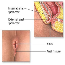 Opinion Anal fissure herbal treatment goes beyond Anal fissure herbal treatment very