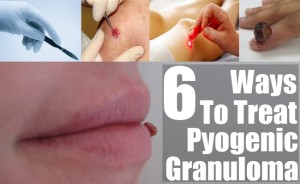 Natural Remedies For Pyogenic Granuloma Natural Remedies For Pyogenic Granuloma