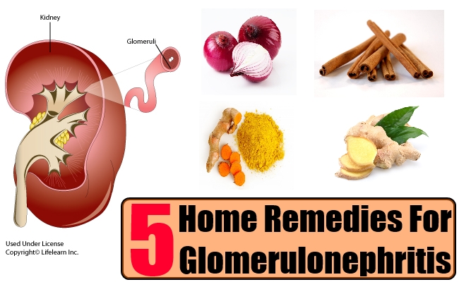 Top 5 Home Remedies For Glomerulonephritis – Natural Home Remedies