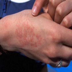 Skin Rash: 59 Pictures, Causes, Treatments - Healthline