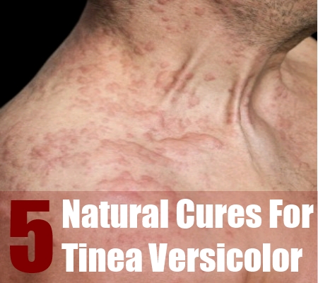Tinea Versicolor And Candida Diet
