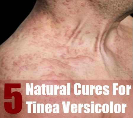 Tinea Corporis - Symptoms, Diagnosis, Treatment of Tinea ...