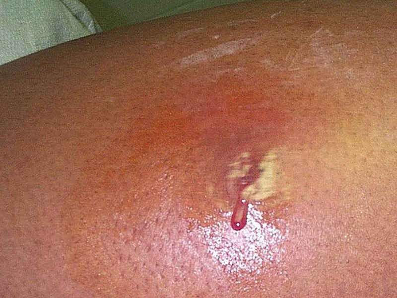Natural Cure For Skin Infection Natural Cure For Skin Infection