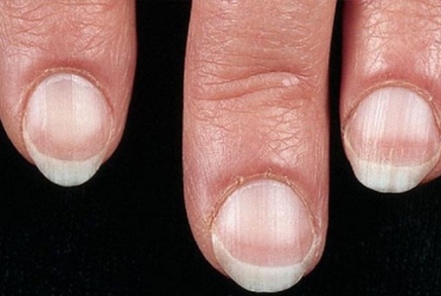 10 Warnings That Your Fingernails Are Indicating – Natural Home