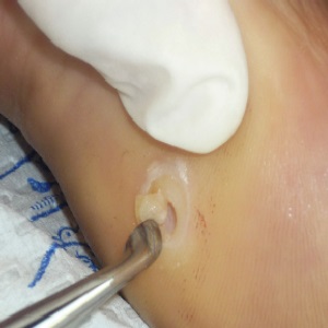 How To Treat Pyogenic Granuloma - Best Tips | Natural Home Remedies ...