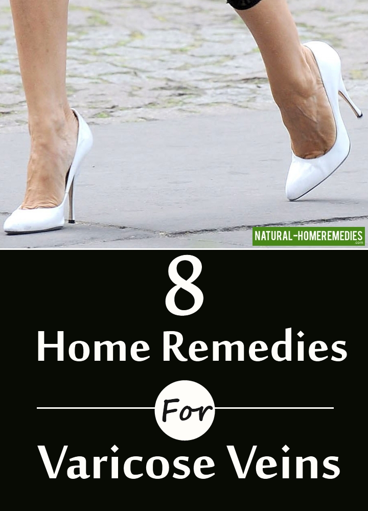 8 Home Remedies For Varicose Veins – Natural Home Remedies & Supplements